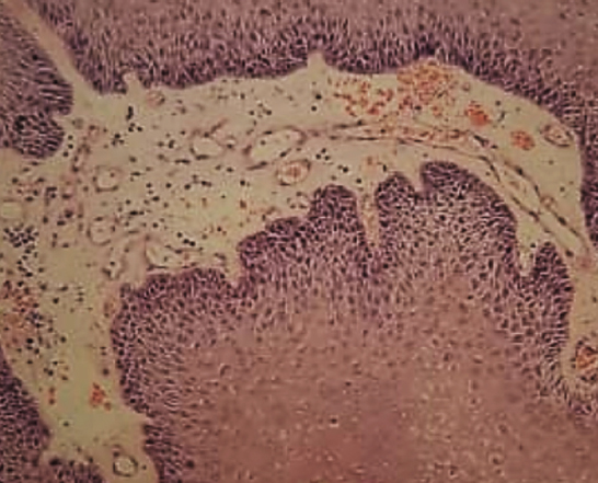 Histopathology showing multiple finger-like projections with hyperkeratotic stratified squamous epithelium and fibrovascular core without any dysplasia suggestive of squamous papillomas (H and E, ×400).